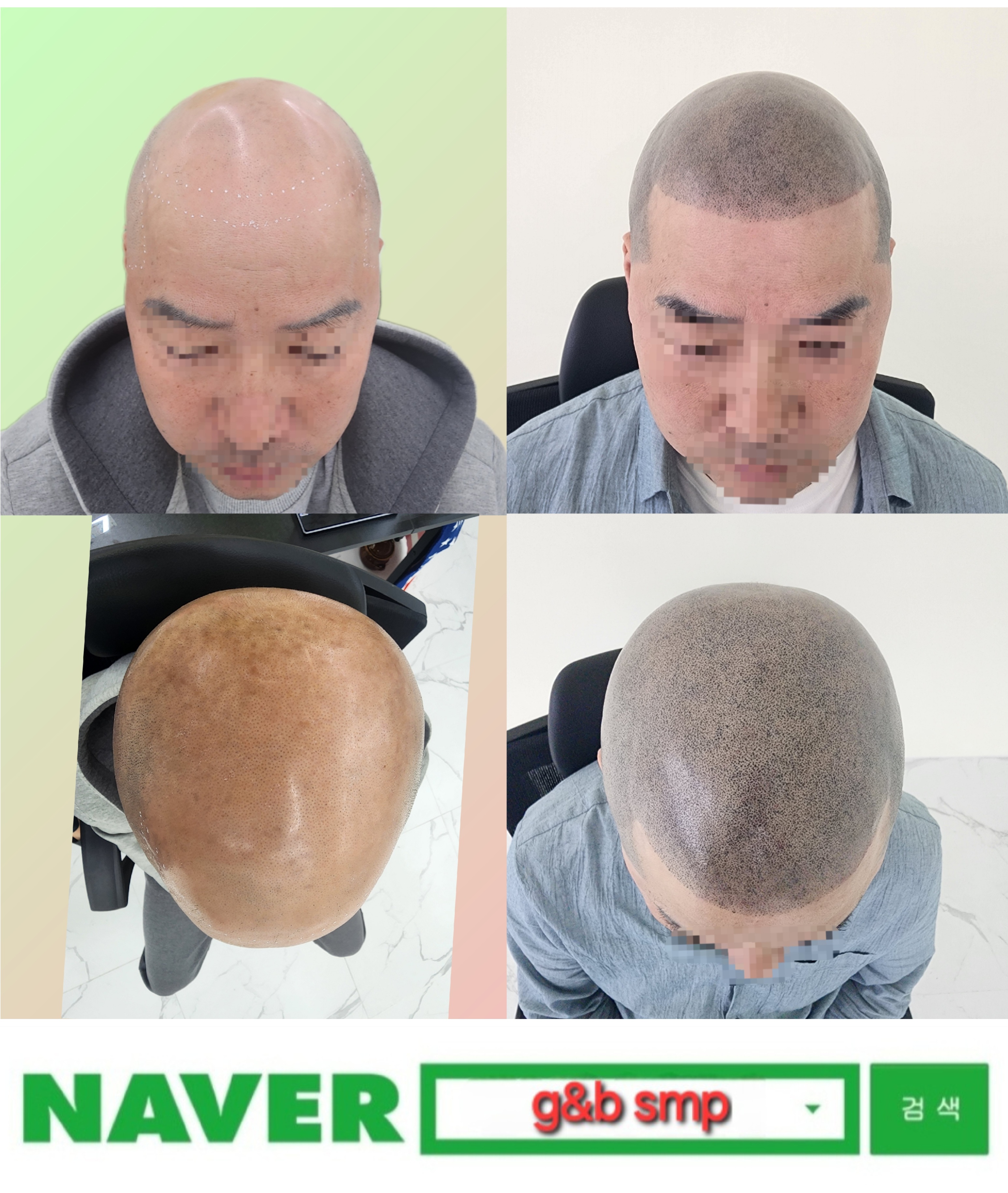 G&b SMP 두피문신