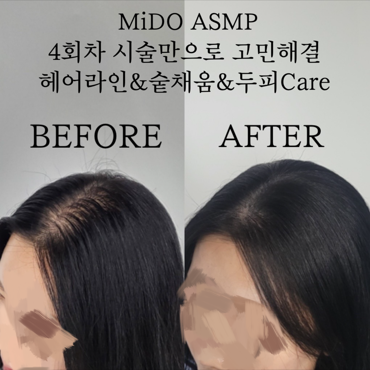 산후탈모 고민 해결! 헤어라인 밀도보강 포트폴리오