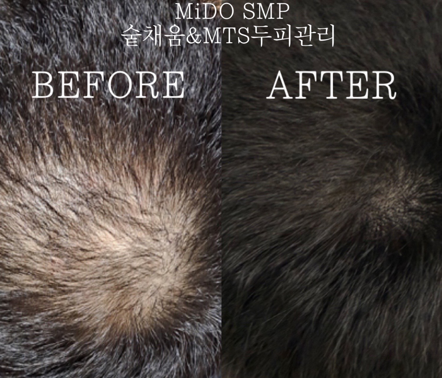 자신감을 되찾은 남성, SMP와 MTS로 탈모 극복하기