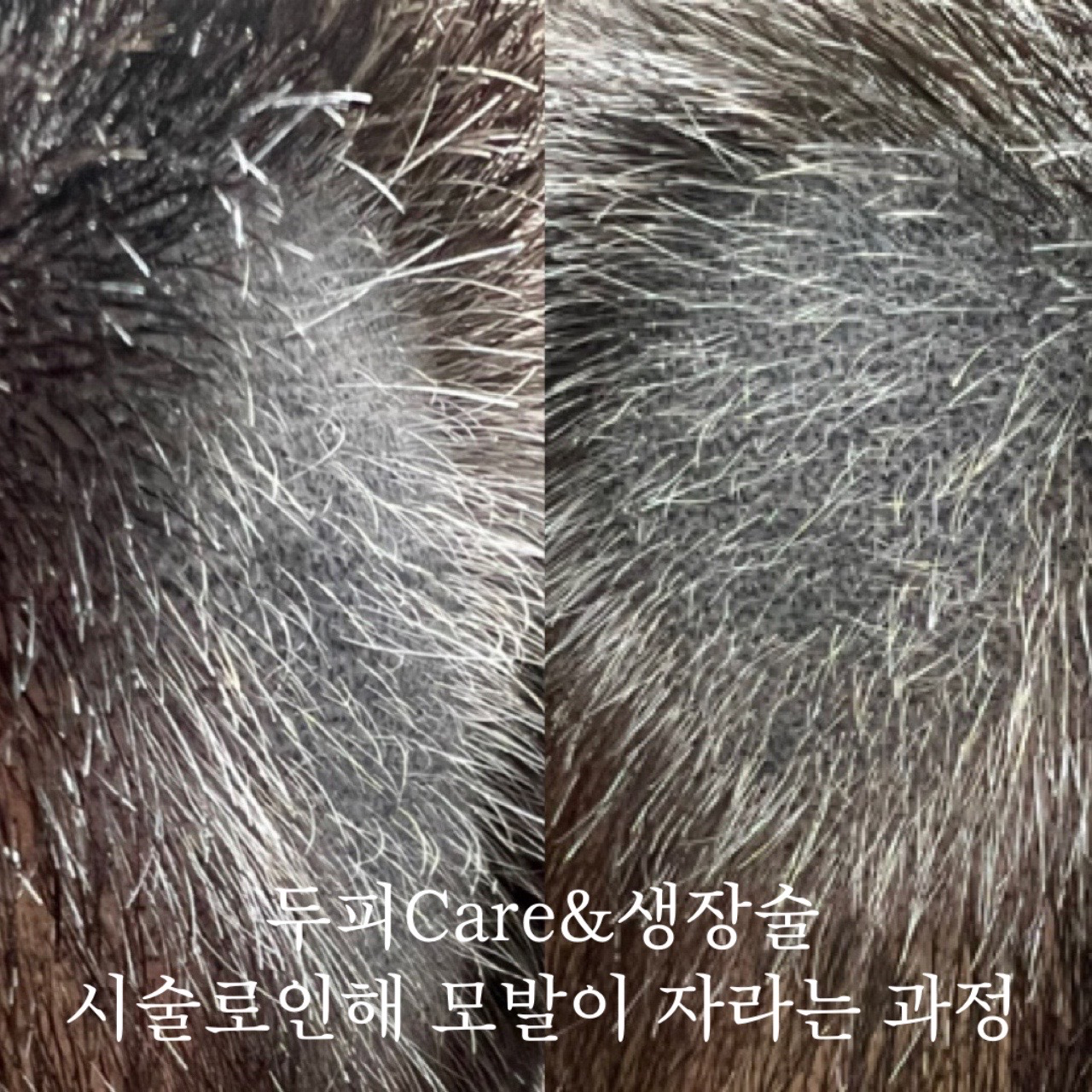 반흔성 탈모와 흉터 커버의 새로운 희망, MIDO의 SMP