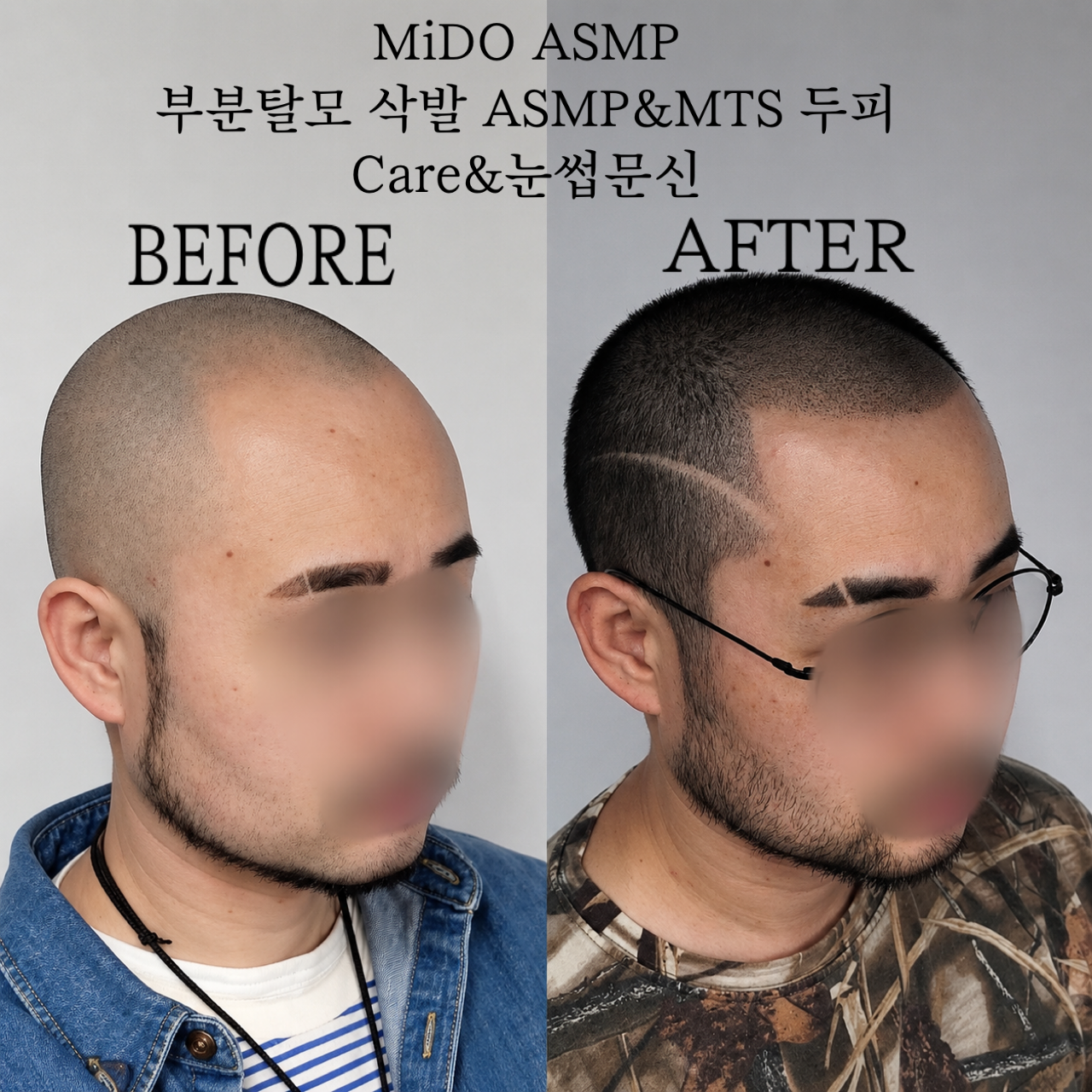 양산시 MIDO의 ASMP 전체삭발&MTS 두피 관리 포트폴리오
