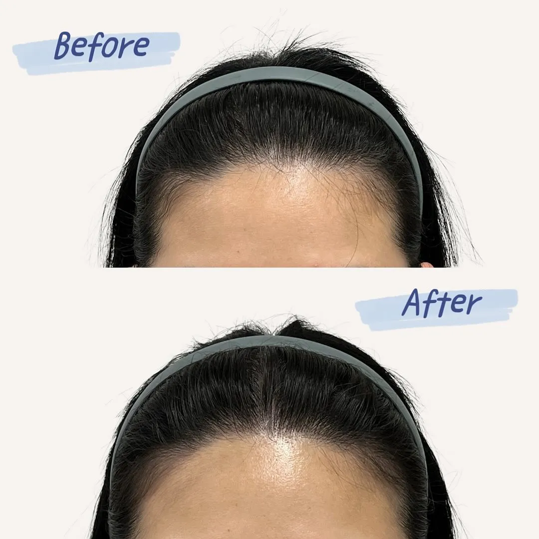 헤어라인 SMP — 이마 라인 교정의 자연스러운 변화