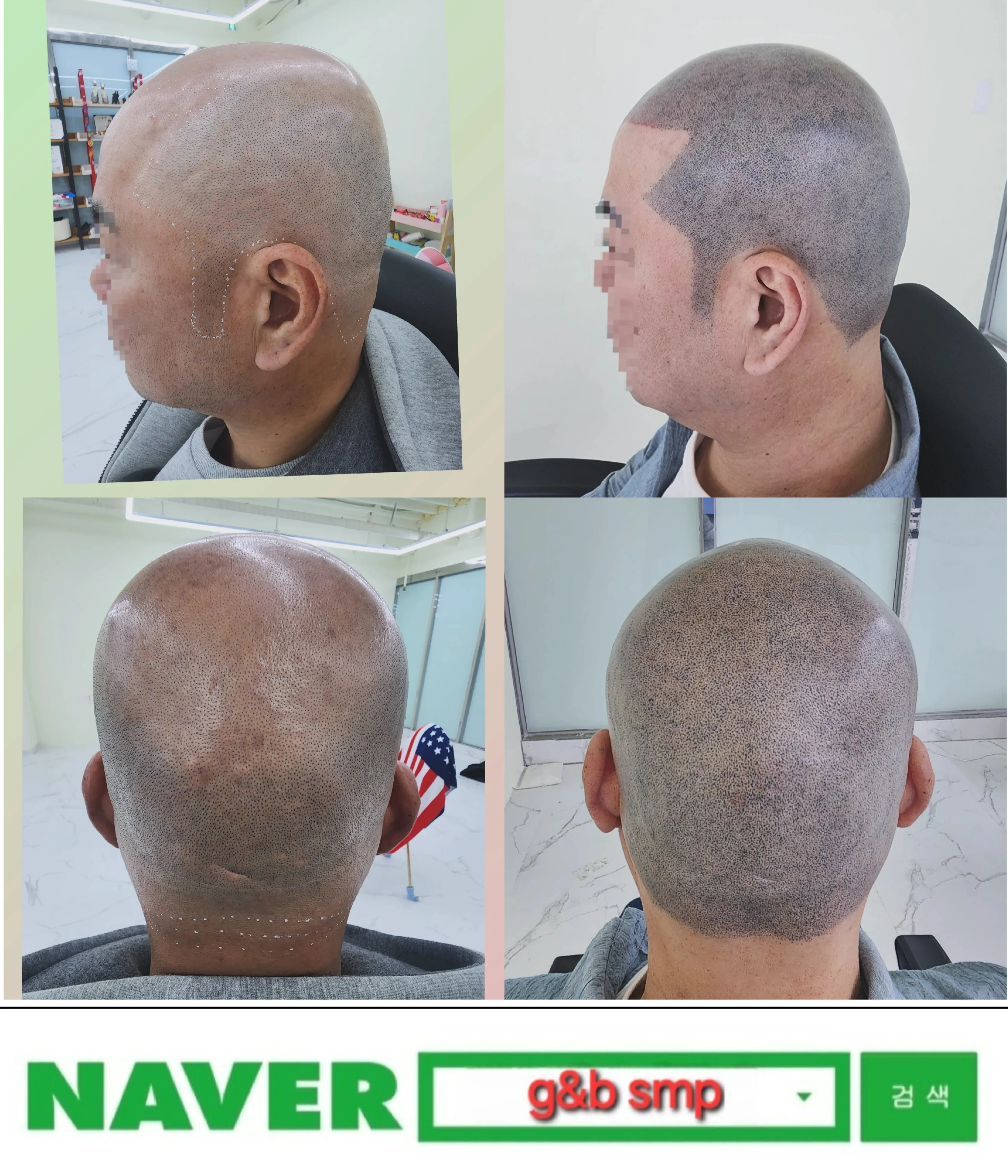 두피문신: 탈모 해결을 위한 SMP 스타일