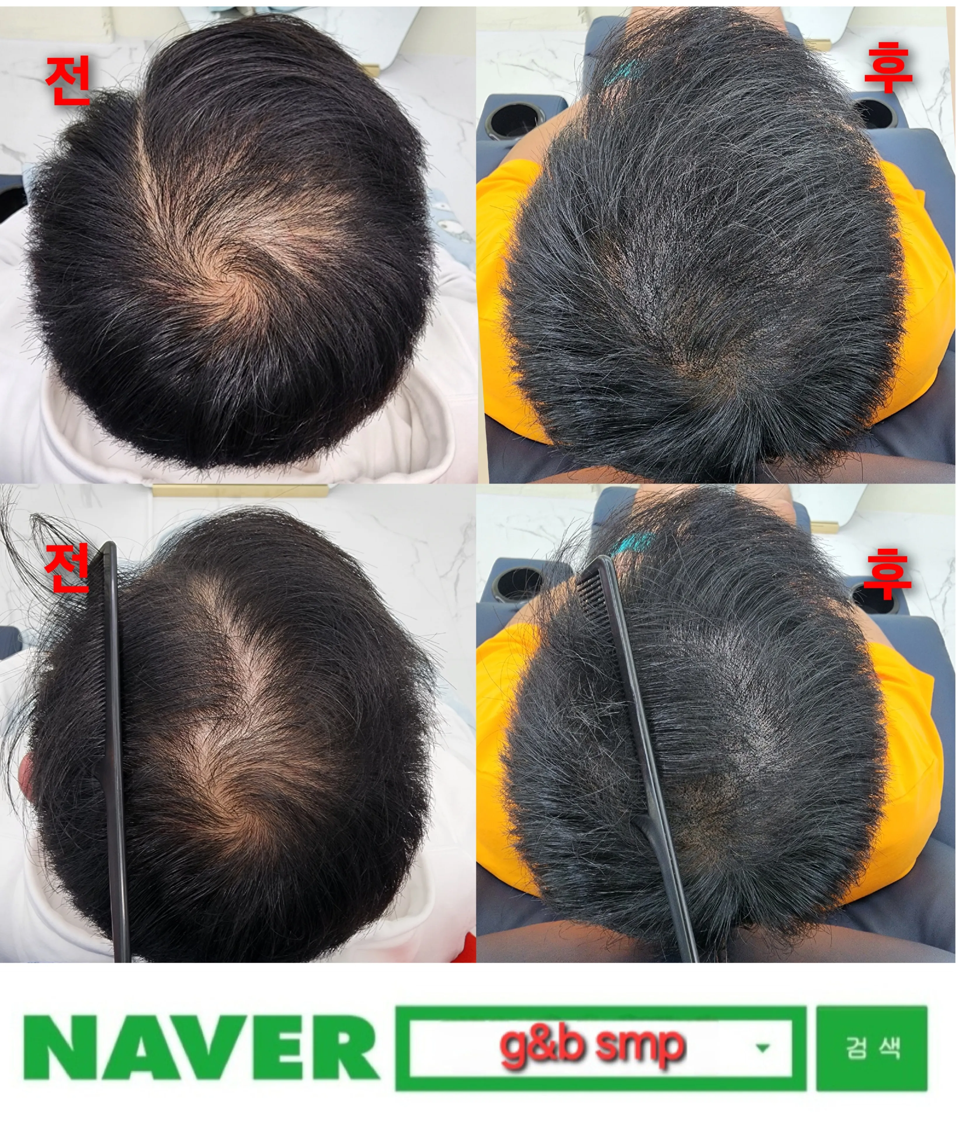 전두 두피문신으로 탈모 고민 해소하기